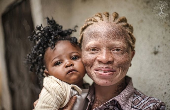RDC : les femmes albinos encouragées à devenir des références en intelligence et en beauté